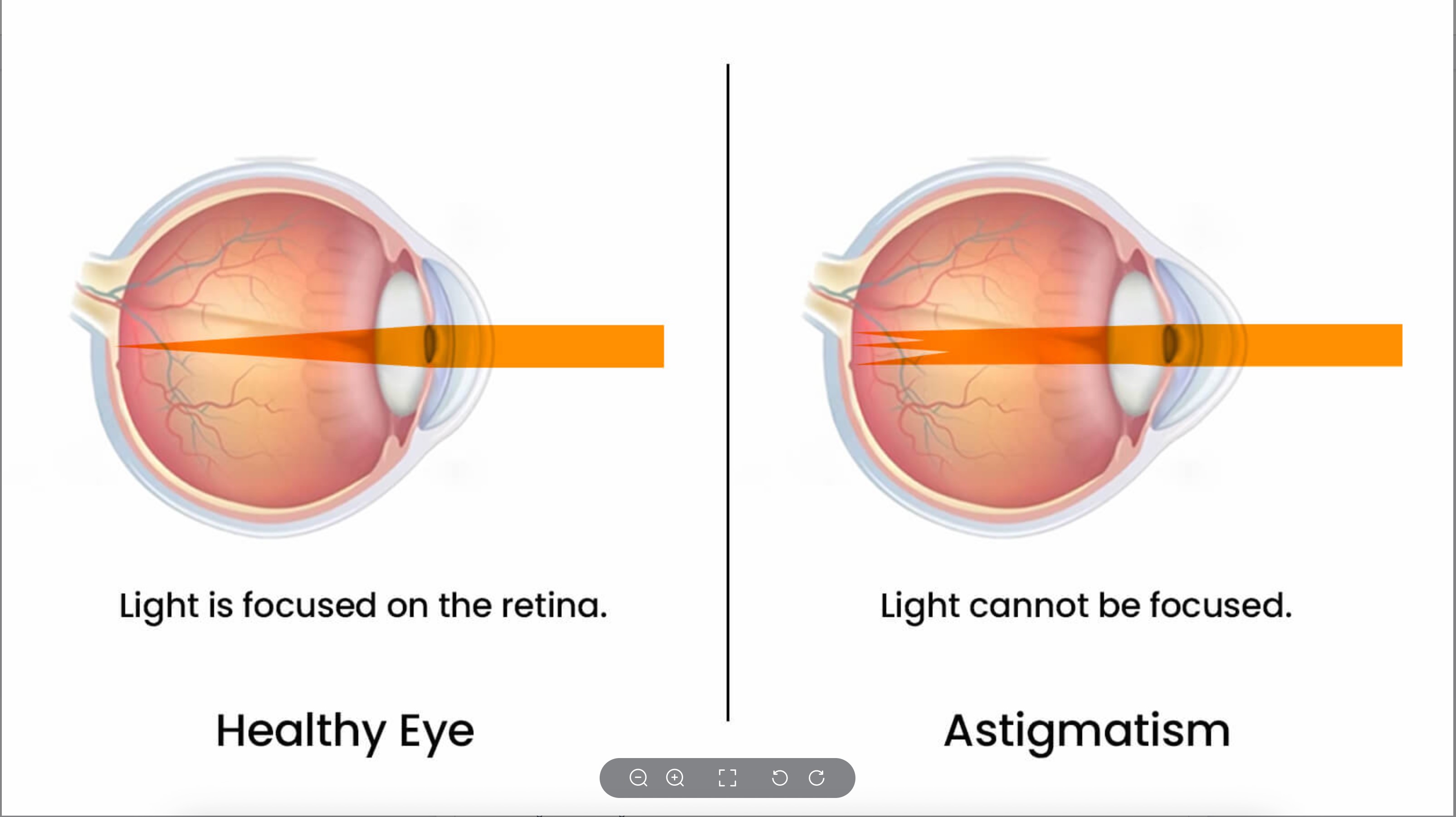 What is Astigmatism? Causes, Symptoms, and Eyes Care Tips